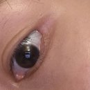 톤즈의원 | [내돈내산] 동탄 톤즈의원 슈링크 유니버스, 눈 비립종 제거 후기