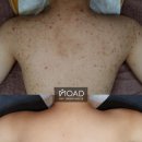 모아드 | 등드름인 줄 알고 계속 치료를 받아도 나아지지 않았던 이유 (건대 피부관리 모아드 후기)