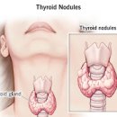 갑상선 유두암 , 갑상선암 (결절, 부음) 이미지