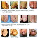 한미정형외과 | 내성발톱 시술해야하나요? 내성발톱 집에서 관리하는 법과 치료 후기!