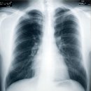 tuberculosis(결핵 結核)과 폐(肺)결핵 이미지