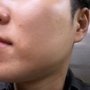 거금의원 | 용인 피부과 메이퓨어의원 수지점, 카프리레이저 여드름 원인 치료 1회차 후기