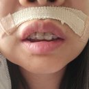 인중의료재단 | 치근단 낭종 완치기념으로 쓰는 치근단 절제술 낭종 제거술 후기