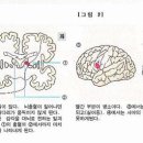 뇌졸중 이미지