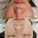 아주그린약국 | 수원,영통 _ 치유함에스테틱 수원점/베르도소 홍조 프리미엄케어 피부관리 후기