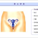 외음부 소양증 이미지