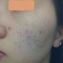 나헌식한의원 | [피부](여드름치료잘하는곳)나헌식한의원/화농성여드름치료 - 9일