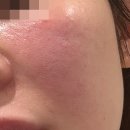 이글스크럽 | 민감성 피부 특징 홍조 붉은기 진정 홈케어