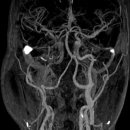 RICA occlusion, LICA severe stenosis 이미지