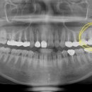 왼쪽 어금니 통증 이미지