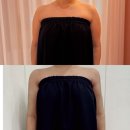 때빼멍 | 신사지방추출주사 팔뚝 무한람스 후기 (가격, 당일 통증,멍)