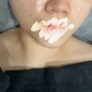 [천안불당동 피부관리샵] 뷰티에이에서 콜드플라 인증샵 물방울리프팅 후기