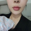 리앤영의원 | 홍대피부과 리앤영의원 입술필러 일주일경과 붓기 멍 후기