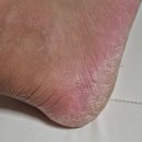 동백바른약국 | 발뒤꿈치갈라짐에 진심인 남편의 변화! 우레아크림 메디율 풋크림 솔직 후기