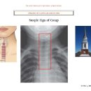 Ch 54 Croup 이미지