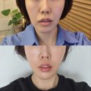 압구정미라클의원 | 압구정피부과 실리프팅 효과 부작용 제대로 받고 와서 대만족 강남리프팅