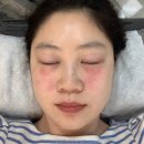 강남왁싱 맛집 콜드플라즈마 눈밑 한관종 제거 후기 제이로랑뷰티스튜디오