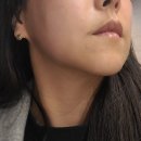 브릴린의원 | 브릴린클리닉 합리적인가격의 슈링크 리프팅찐후기