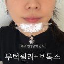라뷰티의원 | 대구쁘띠시술ㅣ반월당역 새로생긴 병원에서 무턱필러1CC+보톡스 내돈내산 후기