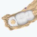 애플치과기공소 이미지