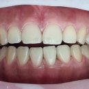 참플란트치과의원 | 대전동구 판암동 &lt;365성심플란트치과&gt;, 원데이 치아 미백, 치아 틈새 개선, 내돈내산 추천!