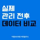이엠러닝(EML)주 | 하남 지방분해주사 실제 관리 전후 비교 리얼