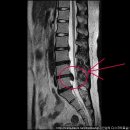 -허리디스크 치료사례11- 조0희님편-(요추4-5번간 추간판 탈출증) 이미지
