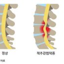 오른쪽 왼쪽 다리저림 원인 8가지 이미지