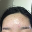 성인한의원 | 성인여드름 원인 말끔 치료했던 한의원 후기