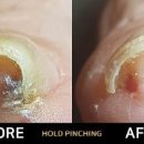 홀드핀칭 이미지