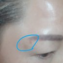 인셀덤신기해대리점 | 인셀덤 사용후기 5일째 - 피부에 나타나는 여러 증상들 기록