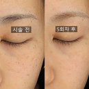 비바덤의원 | [10회 끝!] 내돈내산 옥정 피부과 비바덤의원 주근깨, 기미 제거 리얼 후기