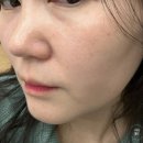 강남역 미술관 피부과 피코토닝 + 비타민 관리 솔직 후기!