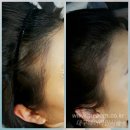 미본헤어 - 포항시 북구 | [대구 미본] 헤어라인시술로 동안얼굴 되기!