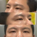 써클 | 신사역 남자눈밑지방재배치레이저 다크써클필러 리얼후기 효과 미쳤음!