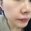 바르는 스킨부스터 위코우노 시술 후기 (시술전후 사진, 효과, 통증, 시술주기)