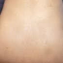 (주)마이크로청담 | '더록시에스테틱 청담' 등강필 솔직 후기 | 등드름이 아니라 막힌 피지였어요! +5일차 각질