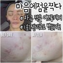 평촌피부관리 마이크로젯 바이오폭스 여드름케어 후기 마음에 점을 찍다 안양점