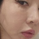 우리제일의원 | 신사역 셀365웰의원 줄기세포 스킨부스터 후기 통증 비용 효과등