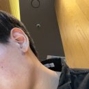 셀메드 드림약국 | 귓볼 피지낭종 원인과 자연치유 하는법 알려드림