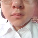 오영수의다나의원 | 남자 수염제모 5주차 후기