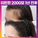 [20대 여자 넓은 M자이마 헤어라인 모발이식] 비절개 히든컷 모발이식 2000모 1년 후기 (모엠의원/헤어라인/전지훈원장) 이미지