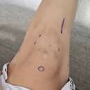 돈삼식당 | 십자인대 재건술 수술 후기 #3 | 통증과 부작용, 재활 일정은?