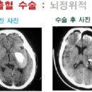 뇌출혈 - 뇌정위적혈종제거술 01 ( 개요 ) 이미지