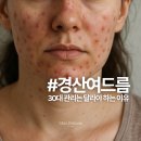 경산환경 한마음직장 | 경산 여드름 30대 관리는 달라야 하는 이유