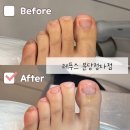백궁가든 | 분당발톱무좀 레푸스 가격 및 발관리 이유진 푸스플레게 후기
