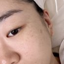 626 | 에클라 스킨 | 수원피부관리 잘하는 곳 추천 콜드플라즈마 잡티 기미 주근깨 제거 후기