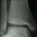 거골 원개(talar dome)의 연골 손상 osteochondritis dissecans의 치료전략 by 김송준 - 과제 이미지