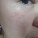 호수인셀덤 - 제주시 | 2019년 6월 2일- 인셀덤 사용후기 22일째, 볼 위 기미 개선, 친구들 반응 후기