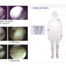 무릎연골수술, 전방십자인대파열, 어깨회전근개파열 모두 관절경수술잘하는곳에서 관절내시경으로 이미지